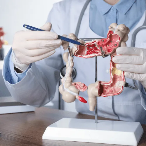 Abordaje Integral de la Enfermedad de Crohn en el Estado de México